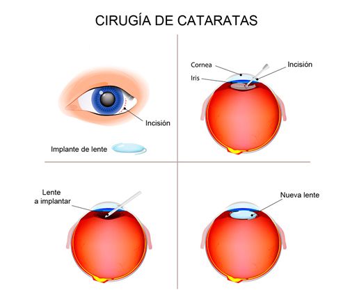 Clínica oftalmológica Dr. Yuste cirugía de cataratas