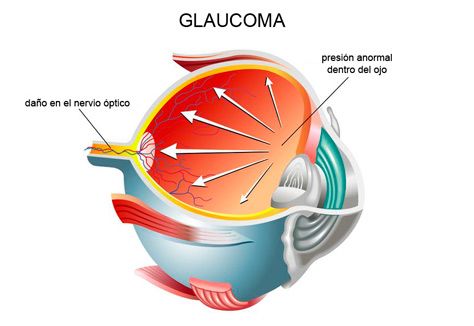 Clínica oftalmológica Dr. Yuste glaucoma