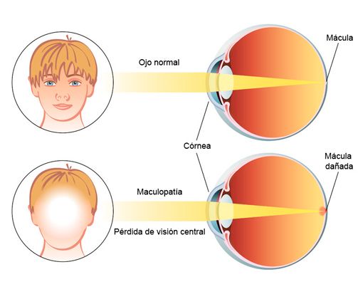 Clínica oftalmológica Dr. Yuste degeneración macular 