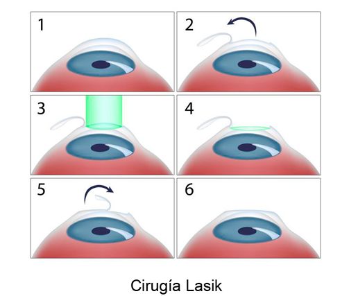 Clínica oftalmológica Dr. Yuste cirugía refractiva